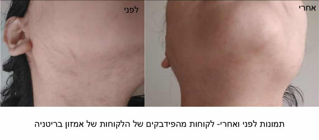 תמונות לפני ואחרי שימוש במכשיר להסרת שיער של בראון זוזו דיליס 01